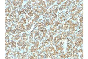 Formalin-fixed, paraffin-embedded human Thyroid Carcinoma stained with EpCAM Rabbit Recombinant Monoclonal Antibody (EGP40/1555R). (Recombinant EpCAM antibody  (N-Term))