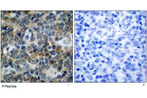 Immunohistochemical analysis of paraffin-embedded human tonsil carcinoma tissue using VASP (phospho S238) polyclonal antibody . (VASP antibody  (pSer238))