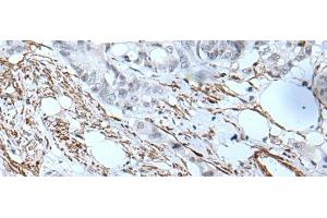 Immunohistochemistry of paraffin-embedded Human colorectal cancer tissue using GJA5 Polyclonal Antibody at dilution of 1:50(x200) (Cx40/GJA5 antibody)
