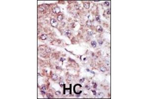 Formalin-fixed and paraffin-embedded human cancer tissue reacted with the primary antibody, which was peroxidase-conjugated to the secondary antibody, followed by AEC staining. (MARK2 antibody  (C-Term))