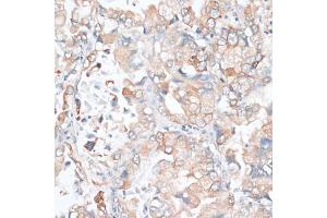 Immunohistochemistry of paraffin-embedded human lung cancer using HMGCR antibody (ABIN6293218) at dilution of 1:100 (40x lens). (HMGCR antibody)