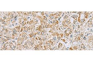 Immunohistochemistry of paraffin-embedded Human liver cancer tissue using INS(C-peptide) Polyclonal Antibody at dilution of 1:40(x200) (Insulin C-Peptide antibody)