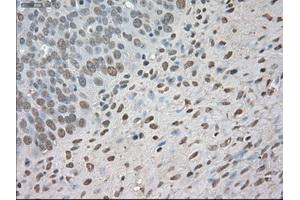 Immunohistochemical staining of paraffin-embedded Adenocarcinoma of colon tissue using anti-BUB1Bmouse monoclonal antibody. (BUB1B antibody)