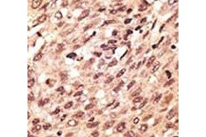IHC analysis of FFPE human hepatocarcinoma stained with the LRP5 antibody (LRP5 antibody  (AA 1538-1567))