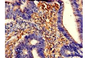 Immunohistochemistry of paraffin-embedded human colon cancer using ABIN7173558 at dilution of 1:100 (TPM3 antibody  (AA 18-224))