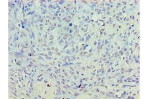 Immunohistochemistry of paraffin-embedded human breast cancer using ABIN7156167 at dilution of 1:100 (PLD5 antibody  (AA 92-536))