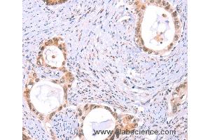 Immunohistochemistry of Human thyroid cancer using PROS1 Polyclonal Antibody at dilution of 1:60