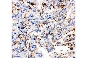 IHC-P: AQP1 antibody testing of human kidney cancer tissue (Aquaporin 1 antibody  (C-Term))
