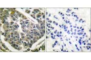 Immunohistochemistry analysis of paraffin-embedded human breast carcinoma tissue, using Collagen IV Antibody. (Collagen IV antibody  (AA 11-60))