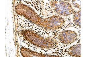 ABIN6257141 and ABIN6274489 at 1/100 staining Human colorectal cancer and adjacent normal tissues by IHC-P. (DUSP9 antibody  (Internal Region))