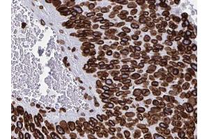 ABIN6268709 at 1/100 staining human Pancreas cancer tissues sections by IHC-P. (Lamin B antibody)