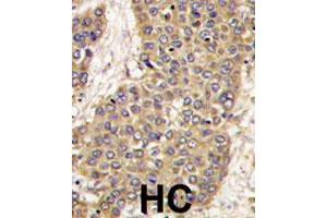 Formalin-fixed and paraffin-embedded human hepatocellular carcinoma reacted with CASP6 polyclonal antibody  , which was peroxidase-conjugated to the secondary antibody, followed by DAB staining. (Caspase 6 antibody  (C-Term))