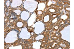 The image on the left is immunohistochemistry of paraffin-embedded Human thyroid cancer tissue using ABIN7131122(SNX11 Antibody) at dilution 1/30, on the right is treated with fusion protein.