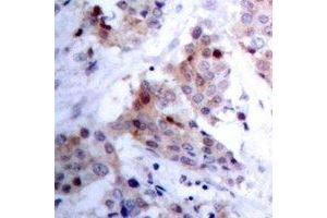 Immunohistochemical analysis of ARHGAP23 staining in human breast cancer formalin fixed paraffin embedded tissue section.