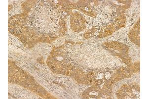 F2RL1 Mouse Monoclonal Antibody at 1/100 staining human lung cancer and adjacent non-tumor tissue by IHC-P.