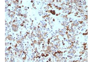Formalin-fixed, paraffin-embedded human Melanoma stained with MITF Mouse Monoclonal Antibody (MITF/915).