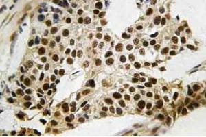 Immunohistochemistry (IHC) analyzes of MAPKAPK-2 antibody in paraffin-embedded human breast carcinoma tissue. (MAPKAP Kinase 2 antibody)