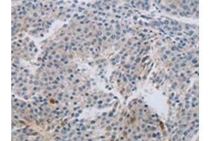 The image on the left is immunohistochemistry of paraffin-embedded Human liver cancer tissue using ABIN7191430(MCMBP Antibody) at dilution 1/60, on the right is treated with synthetic peptide. (MCMBP antibody)