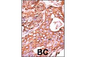 Formalin-fixed and paraffin-embedded human cancer tissue reacted with the primary antibody, which was peroxidase-conjugated to the secondary antibody, followed by AEC staining. (PPM1F antibody  (N-Term))