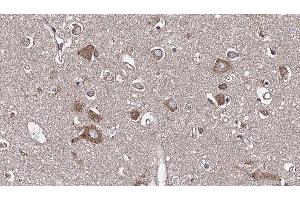 ABIN6277608 at 1/100 staining Human brain cancer tissue by IHC-P. (PSRC1 antibody  (Internal Region))