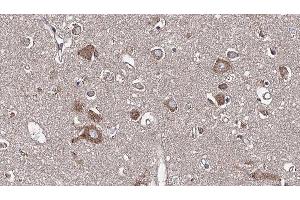 ABIN6277608 at 1/100 staining Human brain cancer tissue by IHC-P.