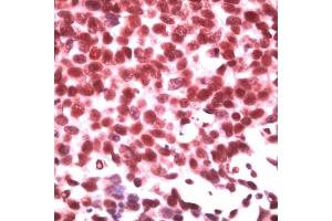 Human breast carcinoma stained with anti-ID3 (ID3 antibody  (C-Term))