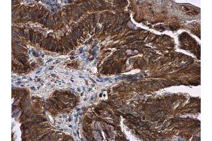 IHC-P Image LOXL2 antibody detects LOXL2 protein at cytoplasm and membrane in human cervical carcinoma by immunohistochemical analysis. (LOXL2 antibody)
