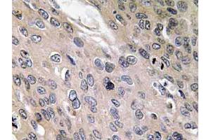 Immunohistochemical analysis of paraffin-embedded human lung cancer tissue using BMP6 polyclonal antibody .