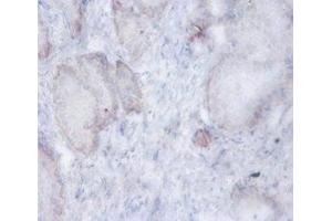 Immunohistochemistry of paraffin-embedded human prostate tissue using ABIN7143582 at dilution of 1:100 (AFG3L2 antibody  (AA 550-759))
