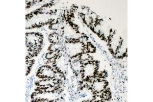 Immunohistochemical analysis of BAF53A staining in human colon cancer formalin fixed paraffin embedded tissue section. (BAF53A antibody  (Center))