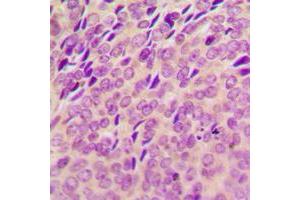 Immunohistochemical analysis of SYK (pY348) staining in human breast cancer formalin fixed paraffin embedded tissue section. (SYK antibody  (pTyr348))