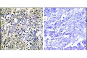 Immunohistochemistry analysis of paraffin-embedded human lung carcinoma tissue, using IGFBP-3 (Ab-183) Antibody. (IGFBP3 antibody  (AA 151-200))
