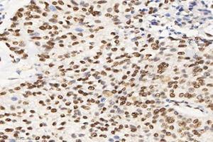 Immunohistochemistry analysis of paraffin-embedded human lung cancer using SET (ABIN7075583) at dilution of 1: 10000 (SET/TAF-I antibody)