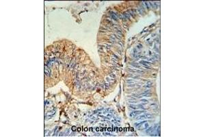 HLA-DRA Antibody (N-term) (ABIN390770 and ABIN2841028) IHC analysis in formalin fixed and paraffin embedded human colon carcinoma followed by peroxidase conjugation of the secondary antibody and DAB staining. (HLA-DRA antibody  (N-Term))