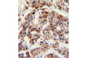 Formalin-fixed and paraffin-embedded human hepatoarcinoma with OTC Antibody (Center), which was peroxidase-conjugated to the secondary antibody, followed by DAB staining. (OTC antibody  (AA 71-98))