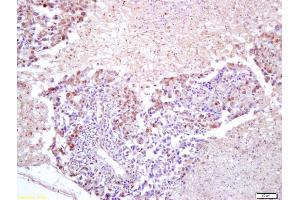 Formalin-fixed and paraffin embedded human lung carcinoma labeled with Anti-FOXM1 Polyclonal Antibody, Unconjugated (ABIN749138) at 1:200 followed by conjugation to the secondary antibody and DAB staining (FOXM1 antibody  (AA 301-400))
