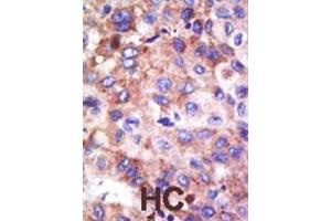 Formalin-fixed and paraffin-embedded human cancer tissue reacted with the primary antibody, which was peroxidase-conjugated to the secondary antibody, followed by DAB staining. (UBE2G1 antibody  (N-Term))