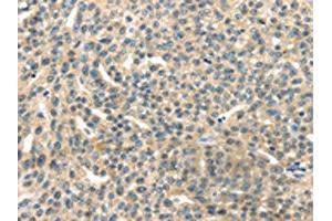 The image on the left is immunohistochemistry of paraffin-embedded Human esophagus cancer tissue using ABIN7192147(RASA2 Antibody) at dilution 1/45, on the right is treated with synthetic peptide. (RASA2 antibody)