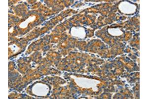 The image on the left is immunohistochemistry of paraffin-embedded Human thyroid cancer tissue using ABIN7130809(RAMP3 Antibody) at dilution 1/40, on the right is treated with fusion protein. (RAMP3 antibody)