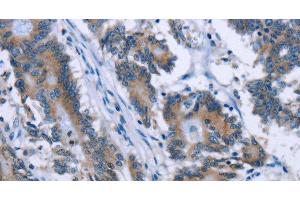 Immunohistochemistry of paraffin-embedded Human colon cancer tissue using PLIN1 Polyclonal Antibody at dilution 1:30 (PLIN1 antibody)