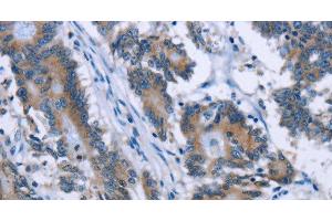 Immunohistochemistry of paraffin-embedded Human colon cancer tissue using PLIN1 Polyclonal Antibody at dilution 1:30