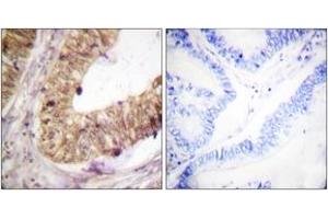 Immunohistochemistry analysis of paraffin-embedded human colon carcinoma tissue, using ATRIP (Ab-68/72) Antibody. (ATRIP antibody  (AA 34-83))