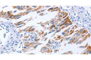Immunohistochemistry of paraffin-embedded Human lung cancer using KIF3A Polyclonal Antibody at dilution of 1:40
