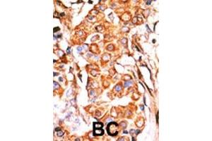 Formalin-fixed and paraffin-embedded human cancer tissue reacted with the primary antibody, which was peroxidase-conjugated to the secondary antibody, followed by AEC staining. (GK2 antibody  (C-Term))