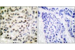 Immunohistochemistry analysis of paraffin-embedded human breast carcinoma tissue, using POLR2A (Ab-1619) Antibody. (POLR2A/RPB1 antibody  (AA 1585-1634))