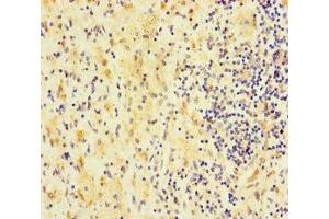 Immunohistochemistry of paraffin-embedded human lung cancer using ABIN7167879 at dilution of 1:100