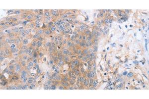 Immunohistochemistry of paraffin-embedded Human esophagus cancer tissue using CD85d Polyclonal Antibody at dilution 1:30 (LILRB2 antibody)