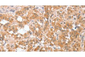 Immunohistochemistry of paraffin-embedded Human thyroid cancer tissue using cPLA2 Polyclonal Antibody at dilution 1:40 (PLA2G4A antibody)
