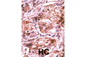 Formalin-fixed and paraffin-embedded human cancer tissue reacted with the primary antibody, which was peroxidase-conjugated to the secondary antibody, followed by AEC staining. (CDC25A antibody  (pSer293))