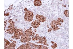 IHC-P Image Immunohistochemical analysis of paraffin-embedded SW480 Xenograft, using S100A11, antibody at 1:500 dilution. (S100A11 antibody)